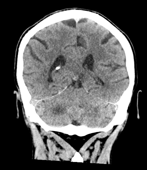 Acute superior cerebellar artery territory infarct (Radiopaedia 84104-99359 Coronal non-contrast 62).jpg