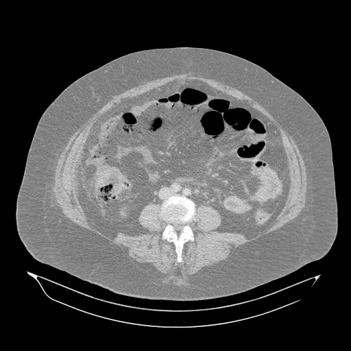 Acute superior mesenteric artery occlusion (Radiopaedia 51288-56960 Axial lung window 37).jpg