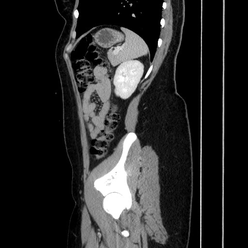Acute uncomplicated appendicitis (Radiopaedia 73704-84499 Sagittal C+ portal venous phase 152).jpg