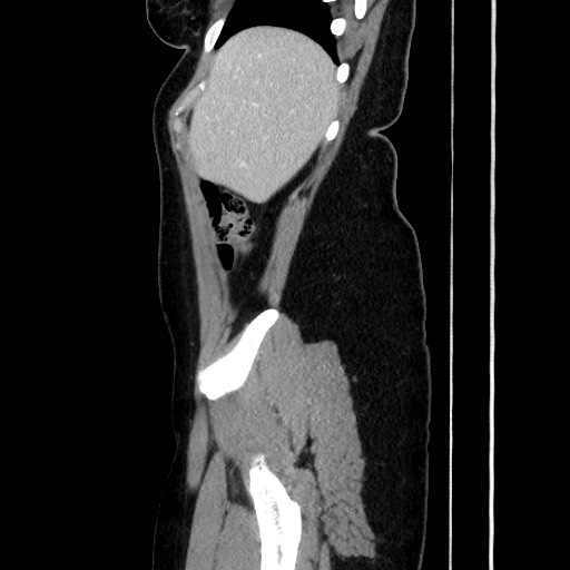 Acute uncomplicated appendicitis (Radiopaedia 73704-84499 Sagittal C+ portal venous phase 58).jpg