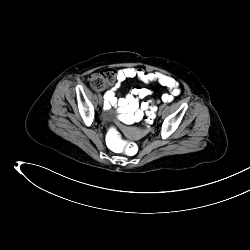 Adenocarcinoma colon with intussusception (Radiopaedia 86006-101922 Axial non-contrast 52).jpg