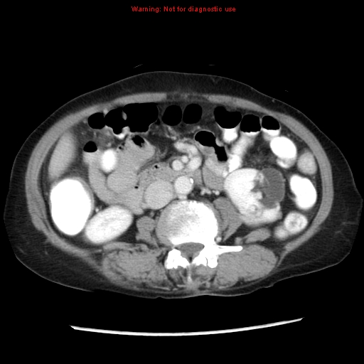Adenocarcinoma of the colon (Radiopaedia 8191-9039 Axial liver window 36).jpg