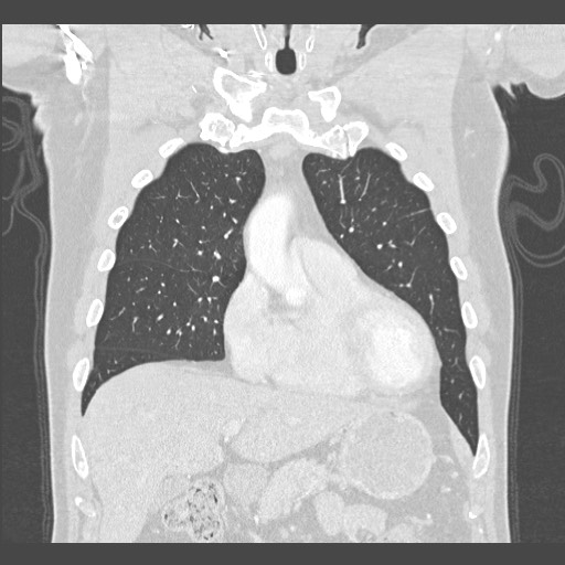 Adenocarcinoma of the lung (Radiopaedia 59871-67325 Coronal lung window 13).jpg