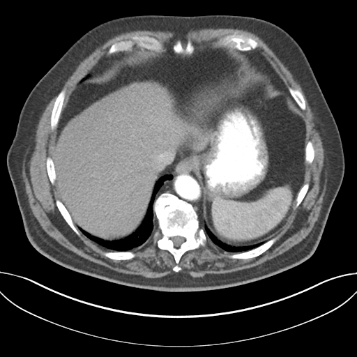 Adenocarcioma of rectum- T1 lesion (Radiopaedia 36921-38547 Axial C+ arterial phase 46).png