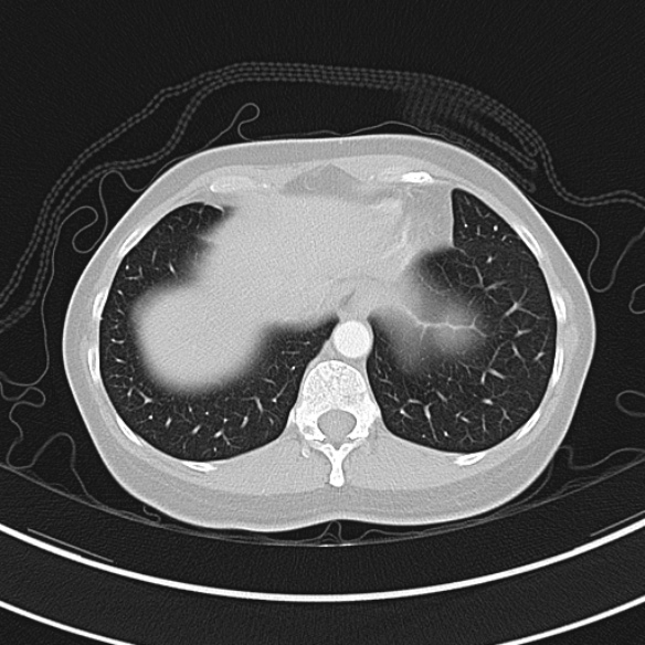 Adenocystic carcinoma of the trachea (Radiopaedia 47677-52525 Axial lung window 71).jpg