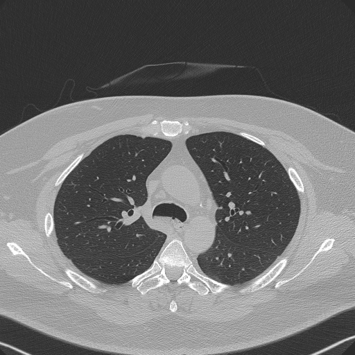 Adenoid cystic carcinoma of the trachea (Radiopaedia 49042-54137 Axial lung window 113).jpg