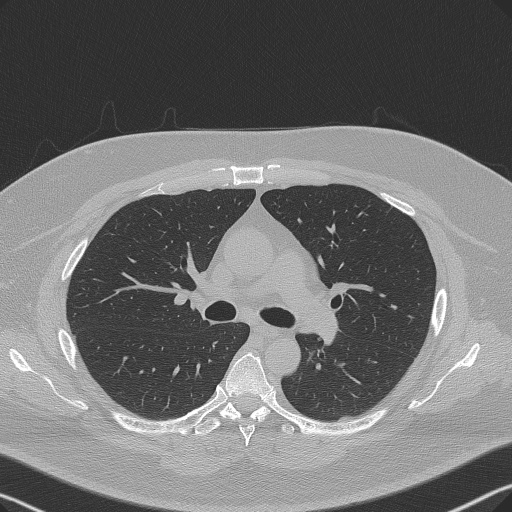 Adenoid cystic carcinoma of the trachea (Radiopaedia 49042-54137 Axial lung window 141).jpg