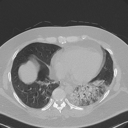 Adenoid cystic carcinoma of the trachea (Radiopaedia 49042-54137 Axial lung window 246).jpg