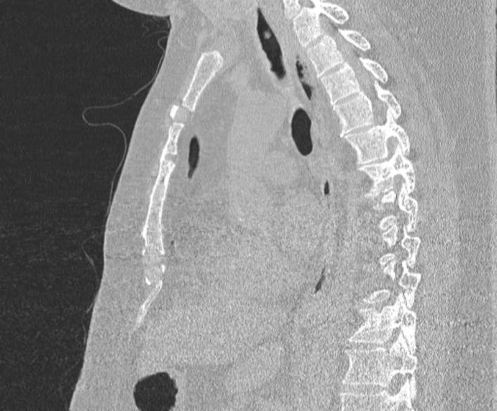 Adenoid cystic carcinoma of the trachea (Radiopaedia 49042-54137 Sagittal lung window 251).jpg