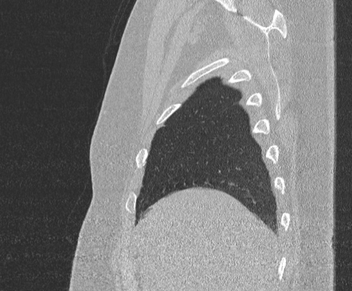 Adenoid cystic carcinoma of the trachea (Radiopaedia 49042-54137 Sagittal lung window 69).jpg