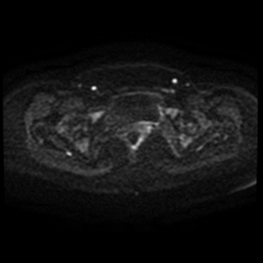 Adenoma malignum of cervix (Radiopaedia 66441-75705 Axial DWI 94).jpg