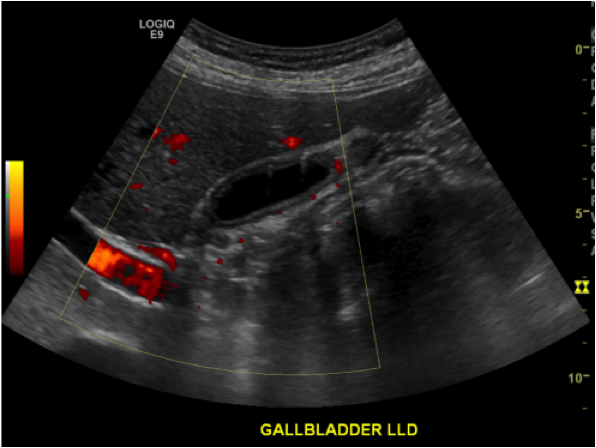 File:Adenomyomatosis of the gallbladder (Radiopaedia 42505).png