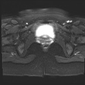 File:Adenomyosis and endometriotic cysts (Radiopaedia 82300-96367 Axial DWI 1).jpg
