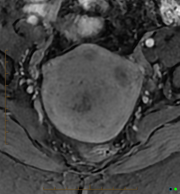 Adenomyosis uterus with hematometra (Radiopaedia 45779-50011 Axial T1 C+ fat sat 21).jpg
