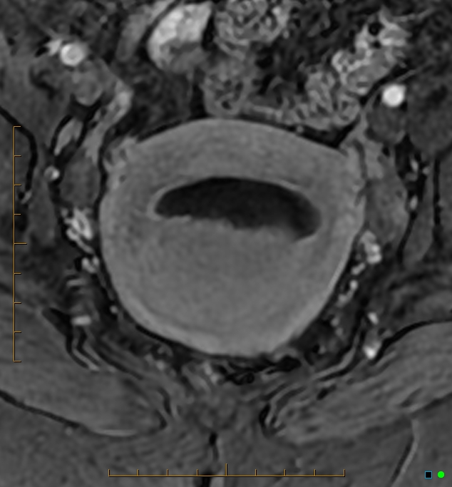Adenomyosis uterus with hematometra (Radiopaedia 45779-50011 Axial T1 C+ fat sat 31).jpg