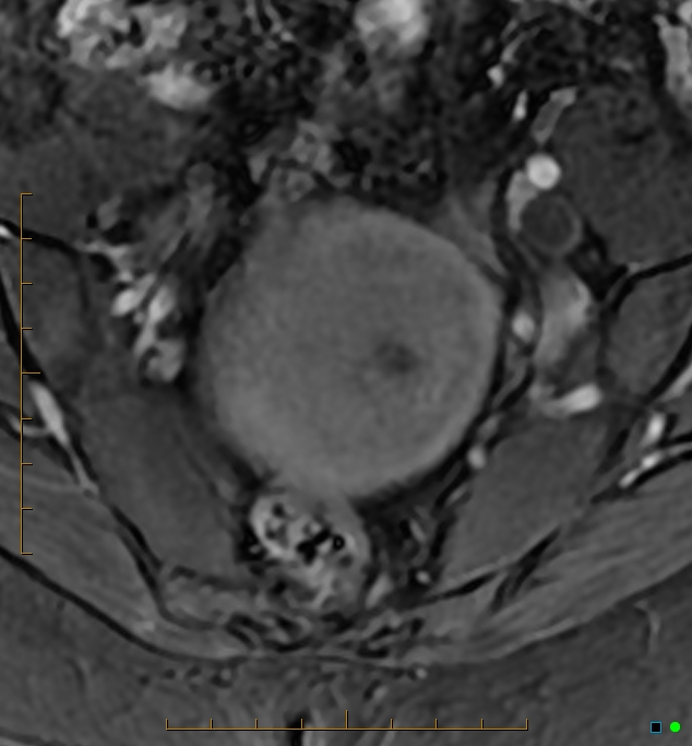 Adenomyosis uterus with hematometra (Radiopaedia 45779-50011 Axial T1 C+ fat sat 8).jpg