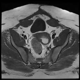 File:Adenomyosis within a didelphys uterus (Radiopaedia 70175-80215 Axial T1 23).jpg