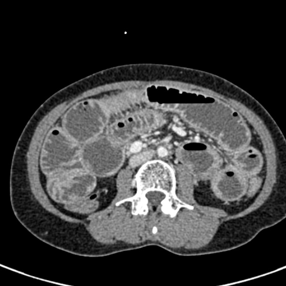 Adhesional small bowel obstruction (Radiopaedia 48397-53305 Axial C+ portal venous phase 41).jpg