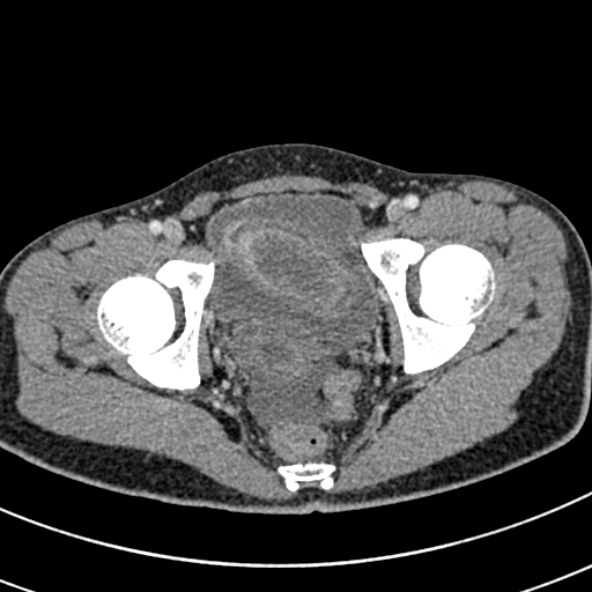 Adhesional small bowel obstruction (Radiopaedia 52107-57980 Axial C+ portal venous phase 119).jpg