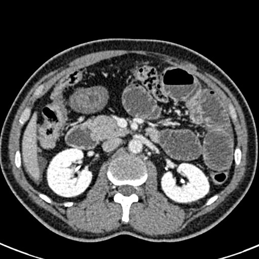 Adhesional small bowel obstruction (Radiopaedia 58900-66131 Axial C+ portal venous phase 20).jpg