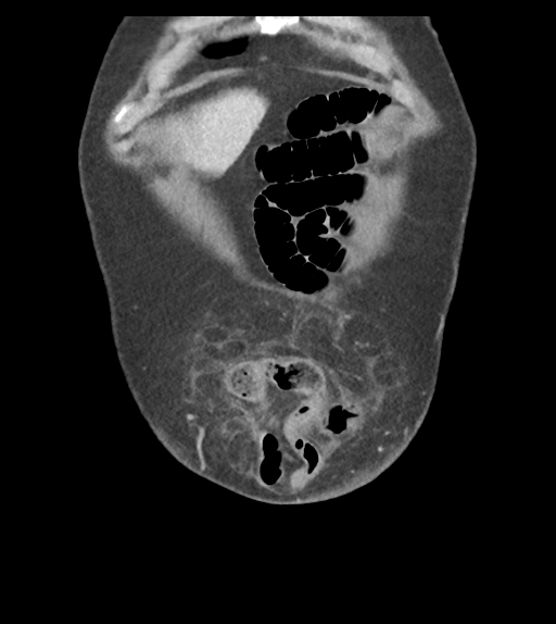 Adhesions within abdominal wall hernia (Radiopaedia 58283-65394 Coronal C+ portal venous phase 12).png
