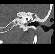 File:Adhesive chronic otitis media (Radiopaedia 14270-14148 Coronal bone window - left 15).jpg