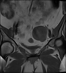 File:Adnexal multilocular cyst (O-RADS US 3- O-RADS MRI 3) (Radiopaedia 87426-103754 Coronal 13).jpg
