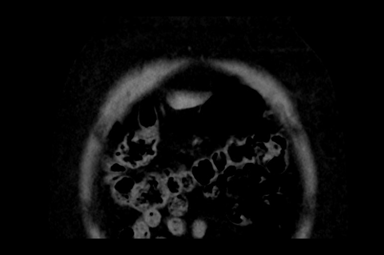 Adrenal cortical carcinoma (Radiopaedia 64017-72769 Coronal non-contrast 8).jpg