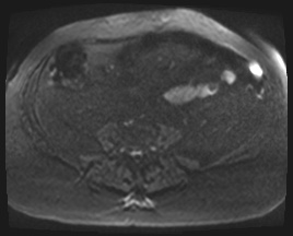 Adrenal cortical carcinoma (Radiopaedia 64017-72770 Axial DWI 127).jpg