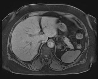 Adrenal cortical carcinoma (Radiopaedia 64017-72770 Axial T1 fat sat 17).jpg
