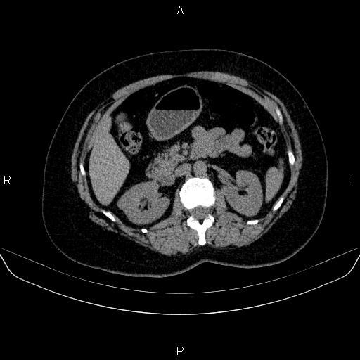 File:Adrenal cortical carcinoma (Radiopaedia 84882-100379 Axial non-contrast 35).jpg