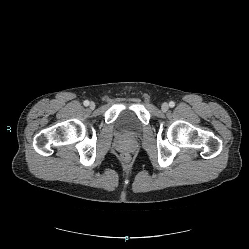 Adrenal cystic lymphangioma (Radiopaedia 83161-97534 Axial C+ portal venous phase 99).jpg