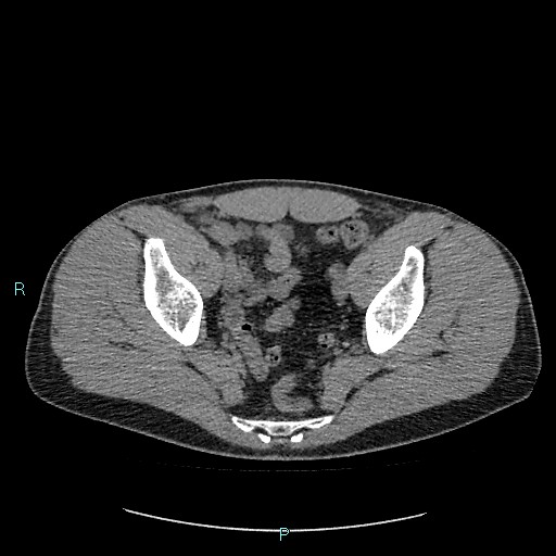 Adrenal cystic lymphangioma (Radiopaedia 83161-97534 Axial non-contrast 85).jpg