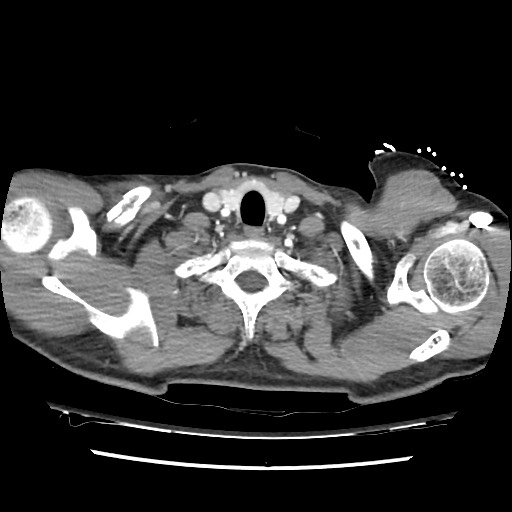 Adrenal gland trauma (Radiopaedia 81351-95078 Axial Dual bolus trauma C+ 10).jpg