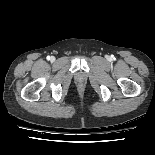 Adrenal gland trauma (Radiopaedia 81351-95078 Axial Dual bolus trauma C+ 123).jpg