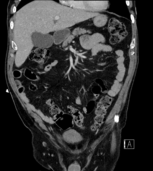 Adrenal lymphoma (Radiopaedia 73730-84529 Coronal C+ portal venous phase 26).jpg