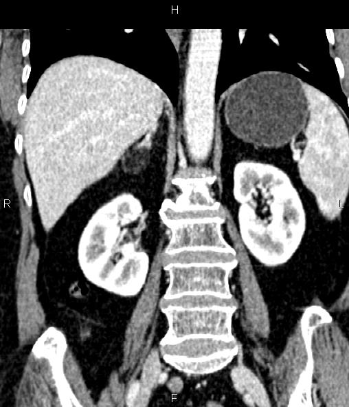Adrenal myelolipoma (Radiopaedia 82742-96986 Coronal renal cortical phase 48).jpg