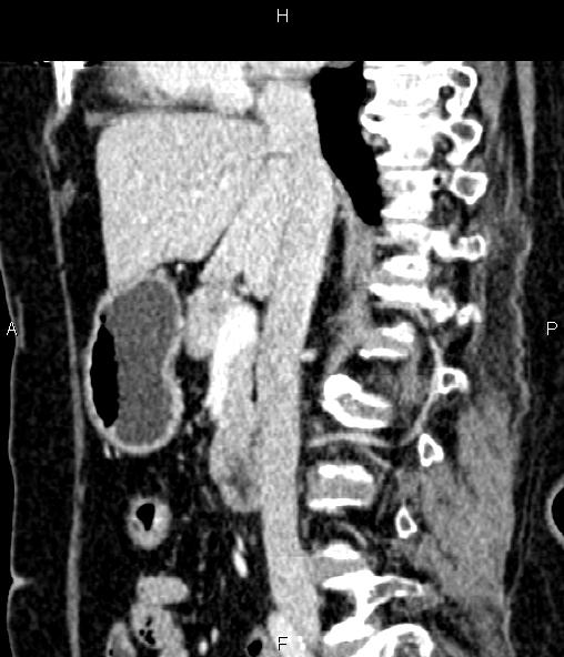 Adrenal myelolipoma (Radiopaedia 82742-96986 Sagittal renal cortical phase 51).jpg
