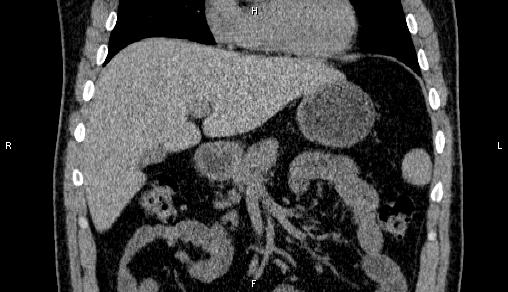 Adrenal myelolipoma (Radiopaedia 84321-99619 Coronal non-contrast 28).jpg