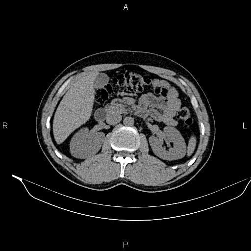 Adrenal myelolipoma (Radiopaedia 87794-104246 Axial non-contrast 42).jpg
