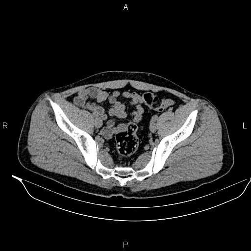 Adrenal myelolipoma (Radiopaedia 87794-104246 Axial non-contrast 88).jpg