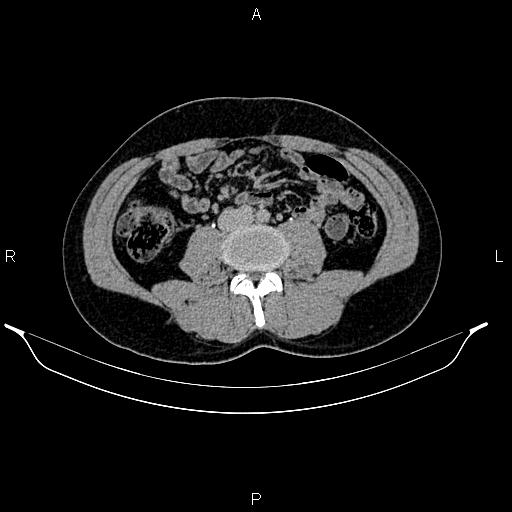 Adrenal myelolipoma (Radiopaedia 87794-104246 Axial renal excretory phase 58).jpg