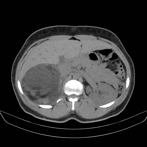 File:Adrenal myelolipoma - bilateral (Radiopaedia 74805-85810 Axial non-contrast 25).jpg