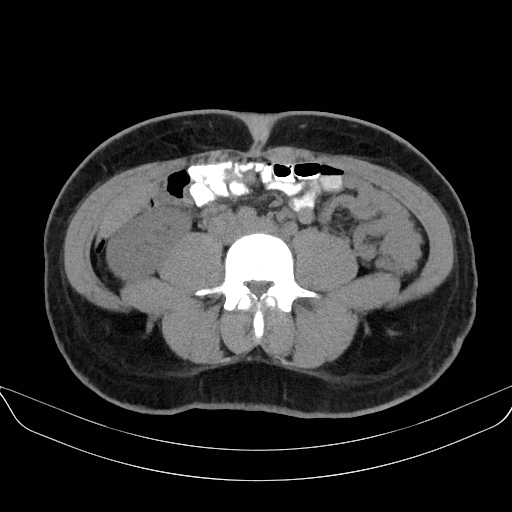 Adrenal myelolipoma - bilateral (Radiopaedia 74805-85810 Axial non-contrast 47).jpg