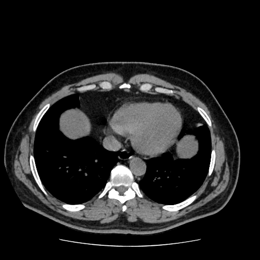 Adrenal myelolipoma and beaver tail liver (Radiopaedia 86201-102193 Axial non-contrast 13).jpg