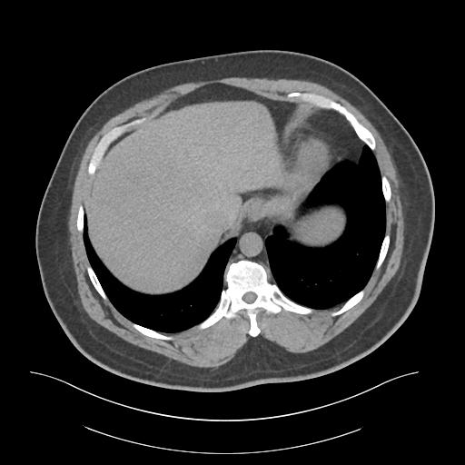 File:Adrenal vein sampling and adrenal nodular hyperplasia - Conn syndrome (Radiopaedia 30561-31337 Axial non-contrast 7).jpg