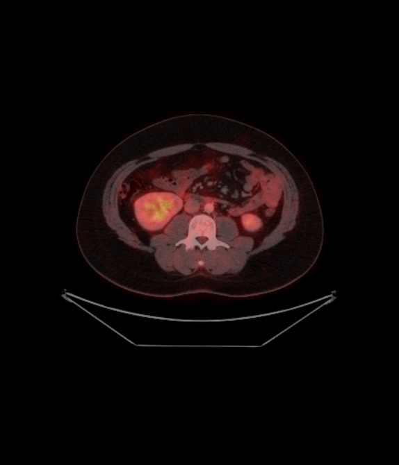 Adrenocortical carcinoma (Radiopaedia 80134-93440 ِAxial 189).jpg