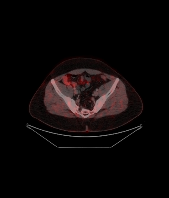 Adrenocortical carcinoma (Radiopaedia 80134-93440 ِAxial 228).jpg