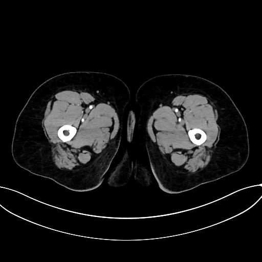 Adrenocortical carcinoma (Radiopaedia 87281-103569 Axial C+ arterial phase 101).jpg
