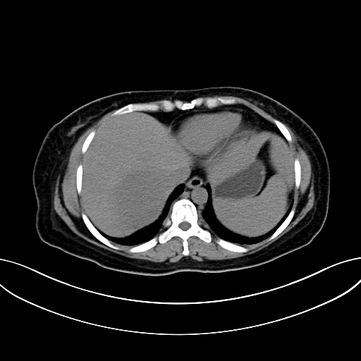 Adrenocortical carcinoma (Radiopaedia 87281-103569 Axial non-contrast 14).jpg